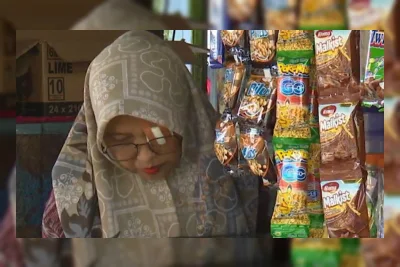 Lupus Penyakit Autoimun Kronis Banyak Serang Wanita, Ini Kata Dokter