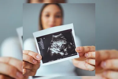 Kisah Ibu di AS Lahirkan Bayi dengan Sindrom Goldenhar Langka