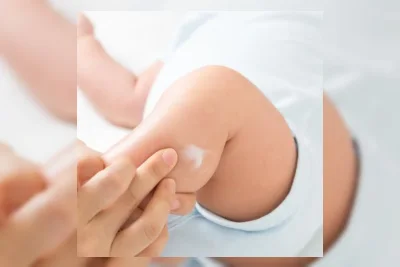 Dokter Ingatkan Aturan Pakai Hydrocortisone untuk Kulit Bayi