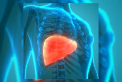 Dokter Ingatkan Perlemakan Hati Sering Serang Usia Produktif