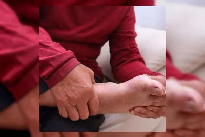 Mengenal Perbedaan Asam Urat dan Rematik Agar Tidak Salah Penanganan