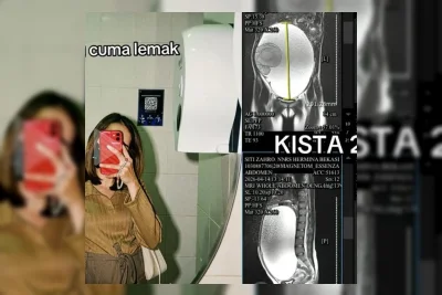 Kista Ovarium 29 Cm Ditemukan di Perut Wanita Bekasi, Awalnya Dikira Lemak
