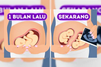 Fenomena Superfetasi: Wanita Bisa Hamil Lagi saat Sedang Hamil
