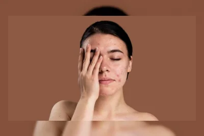 4 Rekomendasi Vitamin dari Dokter Estetika untuk Wajah Berjerawat