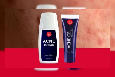 Beda Acne Lotion dan Acne Gel Viva, Kenali Fungsi serta Cara Pakainya sebelum Beli