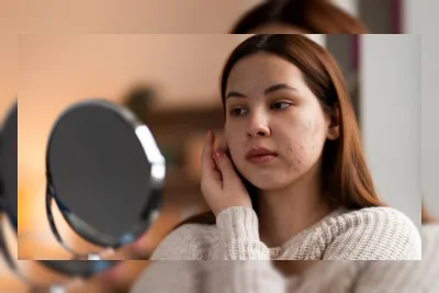 Bisakah Plester Hidrokolloid Hansaplast Atasi Bekas Jerawat di Wajah?