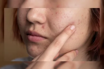 4 Skincare untuk Pudarkan Noda Hitam Bekas Jerawat, Rekomendasi Dokter Estetika