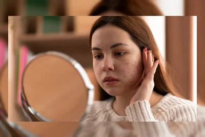 9 Rekomendasi Moisturizer untuk Menghilangkan Bruntusan
