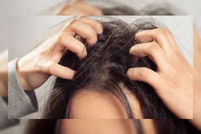 Kulit Kepala Masih Gatal Setelah Keramas? Ini 7 Kemungkinan Penyebabnya