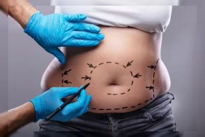 Viral Sedot Lemak Sendiri Rp 1,7 Juta, Dokter Peringatkan Bahayanya