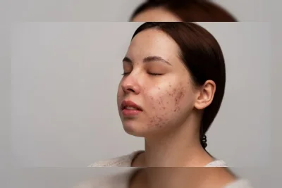 Cushion vs Foundation: Mana yang Lebih Aman untuk Kulit Berjerawat?