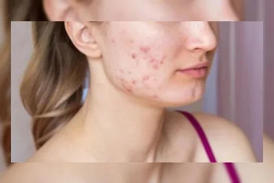 Apa Bedanya Bekas Jerawat PIH dan PIE? Ini Perbedaan hingga Cara Memudarkannya
