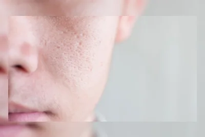 Stop Facial Bulanan, Dokter Rekomendasikan 4 Serum untuk Kecilkan Pori-pori