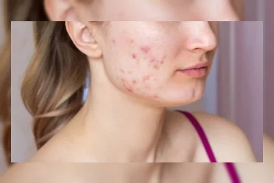 7 Tanda Serum Tidak Cocok di Kulit Wajah, Hentikan Sebelum Rusak Skin Barrier