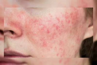 Kulit Wajah Kemerahan? Atasi dengan 7 Kandungan Skincare Ini