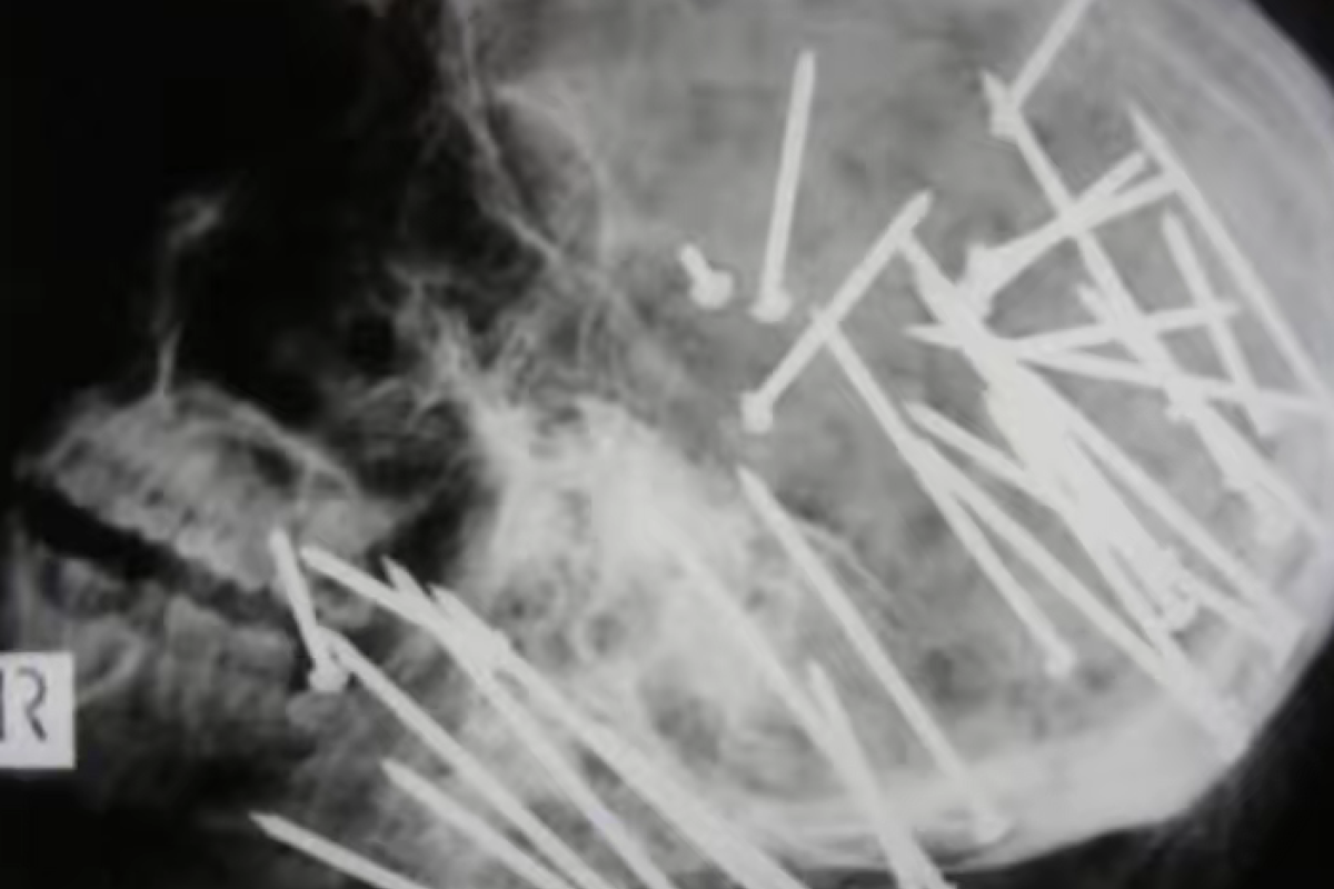 Foto Tengkorak Chen Liu Ditembak Pistol Paku di Australia Viral: Fakta Tragis di Balik Gambar X-Ray yang Heboh, Benarkah AI?